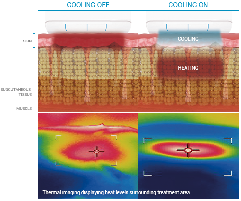 CONTACT-COOLING-CONTROL01 | ULTRAFORMER